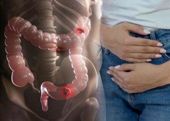 Kanker Usus Besar di Usia Muda Melonjak, Yuk Ketahui Pemicunya