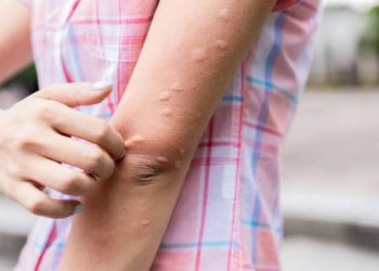 5 Cara Alami Mengatasi Biduran Saat Musim Hujan, Tanpa Efek Samping