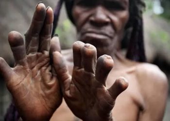 Mengenal Tradisi Potong Jari Suku Dani, Simbol Duka Cita Mendalam